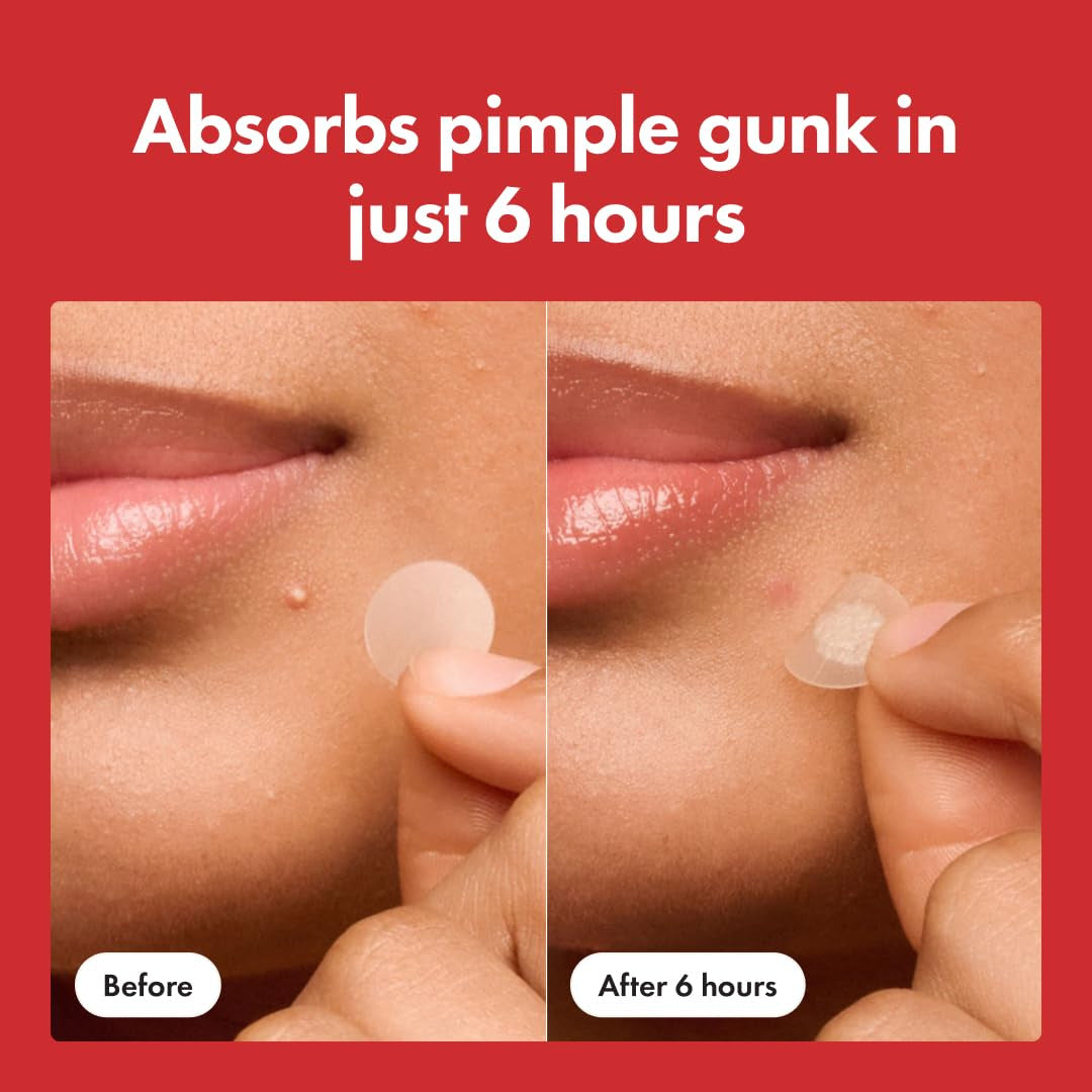 Mighty Patch Pimple Patches